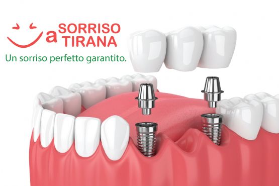 Turismo dentale, Turismo Dentale in Albania, best dentist in tirana dentista albania, albania dentist prices, elite dental tirana, dental clinic albania